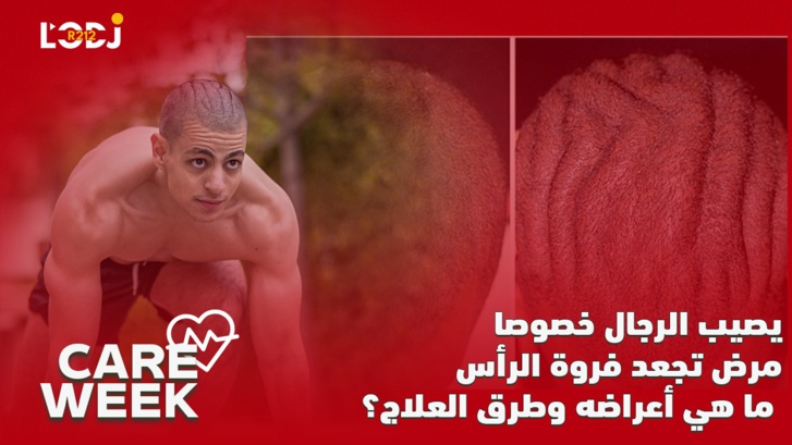 Care Week : يعاني منه طه إيسو، مرض تجعد فروة الرأس، ما هي أعراضه وطرق العلاج ؟ Care Week : يعاني منه طه إيسو، مرض تجعد فروة الرأس، ما هي أعراضه وطرق العلاج ؟