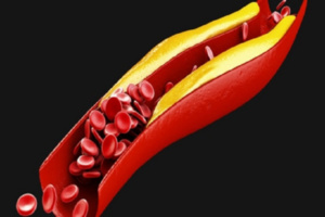 الكوليسترول الضار.. مخاطره الصحية وكيفية مواجهته الكوليسترول الضار.. مخاطره الصحية وكيفية مواجهته