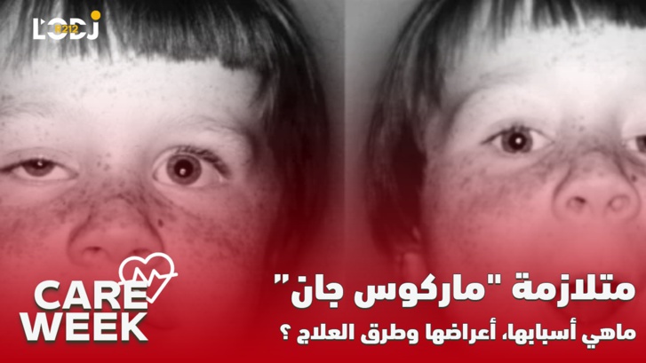 Care Week : متلازمة "ماركوس جان، ماهي أسبايها، أعراضها وطرق العلاج ؟ Care Week : متلازمة "ماركوس جان، ماهي أسبايها، أعراضها وطرق العلاج ؟