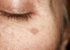 انتهاء الصيف ومشاكل البقع الداكنة.. وصفات طبيعية لتخفيفها انتهاء الصيف ومشاكل البقع الداكنة.. وصفات طبيعية لتخفيفها