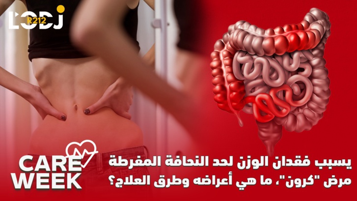 Care Week : يسبب فقدان الوزن لحد النحافة المفرطة ، مرض "كرون"، ما هي أعراضه وطرق العلاج Care Week : يسبب فقدان الوزن لحد النحافة المفرطة ، مرض "كرون"، ما هي أعراضه وطرق العلاج