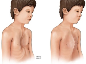 اليوم الوطني الأول لمتلازمة مارفان اضطرابٌ وراثي نادر في النسيج الضام اليوم الوطني الأول لمتلازمة مارفان اضطرابٌ وراثي نادر في النسيج الضام