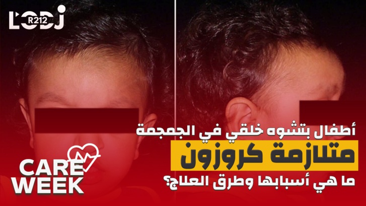 Care Week : أطفال بتشوه خلقي في الجمجمة، متلازمة كروزون، ما هي أسبابها وطرق العلاج؟ Care Week : أطفال بتشوه خلقي في الجمجمة، متلازمة كروزون، ما هي أسبابها وطرق العلاج؟