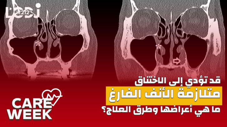 Care Week : قد تؤدي إلى الاختناق، متلازمة الأنف الفارغ، ما هي أعراضها وطرق العلاج؟ Care Week : قد تؤدي إلى الاختناق، متلازمة الأنف الفارغ، ما هي أعراضها وطرق العلاج؟