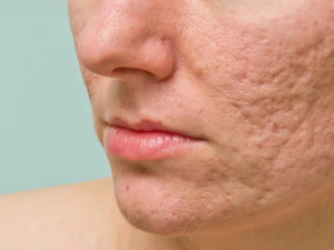 تعرفي على وصفات طبيعية للتخلص من حب الشباب تعرفي على وصفات طبيعية للتخلص من حب الشباب