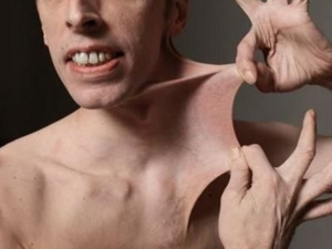 متلازمة "إيلرز دانلوس"، ما هي أعراضها وطرق العلاج؟ متلازمة "إيلرز دانلوس"، ما هي أعراضها وطرق العلاج؟