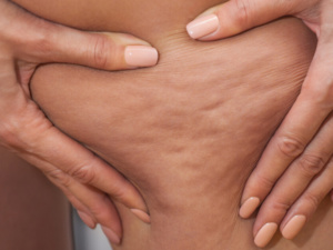 خمس نصائح طبية فعّالة لعلاج السيلوليت لدى النساء خمس نصائح طبية فعّالة لعلاج السيلوليت لدى النساء
