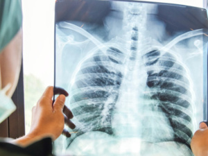 تفاقم مرض السل في المغرب عام 2024: أسباب وتأثيرات تفاقم مرض السل في المغرب عام 2024: أسباب وتأثيرات