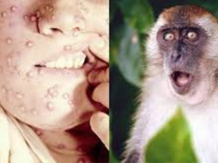 جدري القردة يثير مخاوف الباحثين بسبب طفراته الأخيرة جدري القردة يثير مخاوف الباحثين بسبب طفراته الأخيرة