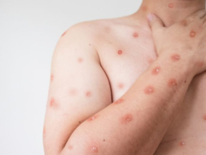 10 اختلافات للتمييز بين جدري القردة وجدري الماء 10 اختلافات للتمييز بين جدري القردة وجدري الماء