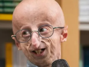 بعد وفاة طفل الشيخوخة المبكرة : اكتشف مرض البروجيريا وأهم أعراضه بعد وفاة طفل الشيخوخة المبكرة : اكتشف مرض البروجيريا وأهم أعراضه