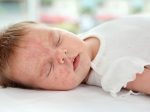 الحساسية الغذائية عند الرضع وكيفية التعامل معها  الحساسية الغذائية عند الرضع وكيفية التعامل معها