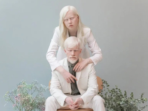 المهق: التفاصيل الكاملة عن هذا المرض الوراثي المهق: التفاصيل الكاملة عن هذا المرض الوراثي