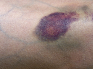 كدمات الجلد : كيف تحدث وما هي طرق العلاج السريعة؟ كدمات الجلد : كيف تحدث وما هي طرق العلاج السريعة؟