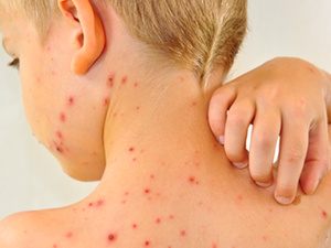 ارتفاع إصابات الحصبة عالميًا بنسبة 20% في 2023 ارتفاع إصابات الحصبة عالميًا بنسبة 20% في 2023