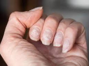 علامة على الأظافر قد تكون تحذيرا مبكرا لارتفاع مستويات الكوليسترول في الدم علامة على الأظافر قد تكون تحذيرا مبكرا لارتفاع مستويات الكوليسترول في الدم