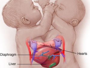 نجاح 4 عمليات لفصل توائم ملتصقة في المغرب نجاح 4 عمليات لفصل توائم ملتصقة في المغرب