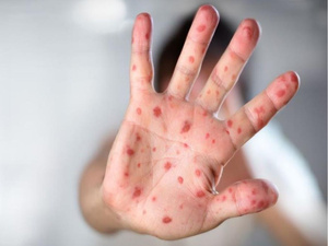 التهراوي : وفيات الحصبة تتجاوز 100 حالة... ونصف الضحايا أطفال التهراوي : وفيات الحصبة تتجاوز 100 حالة... ونصف الضحايا أطفال