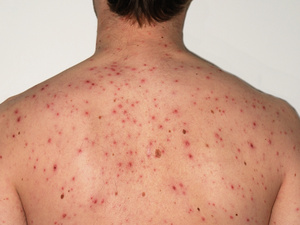 المندوبية العامة للسجون تسجل 41 إصابة بـ"بوحمرون" وتطلق خطة وقائية المندوبية العامة للسجون تسجل 41 إصابة بـ"بوحمرون" وتطلق خطة وقائية