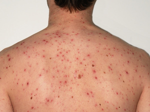 إدارة السجون تعلن عن 79 حالة إصابة جديدة بالحصبة إدارة السجون تعلن عن 79 حالة إصابة جديدة بالحصبة