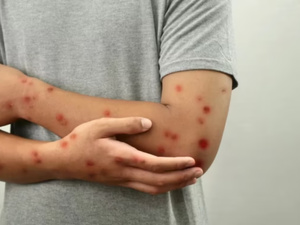 حصبة التلاميذ تؤجل الامتحانات.. ووزارة التعليم تضمن الاستدراك حصبة التلاميذ تؤجل الامتحانات.. ووزارة التعليم تضمن الاستدراك