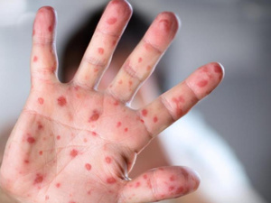 لتطويق الداء، مذكرة وزارية تستبعد التلاميذ المصابين ببوحمرون من المدارس  لتطويق الداء، مذكرة وزارية تستبعد التلاميذ المصابين ببوحمرون من المدارس