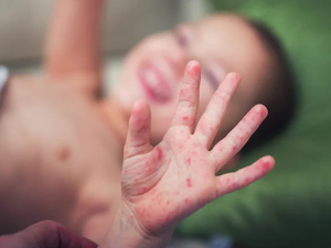 الحصبة تواصل انتشارها في المغرب بأكثر من 3 آلاف إصابة و6 وفيات خلال أسبوع الحصبة تواصل انتشارها في المغرب بأكثر من 3 آلاف إصابة و6 وفيات خلال أسبوع