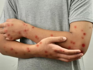 حصيلة الحصبة في المغرب : 2863 إصابة و8 وفيات خلال أسبوع حصيلة الحصبة في المغرب : 2863 إصابة و8 وفيات خلال أسبوع