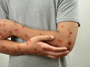 انخفاض قياسي لإصابات "بوحمرون" بالمغرب بنسبة تفوق 80% انخفاض قياسي لإصابات "بوحمرون" بالمغرب بنسبة تفوق 80%