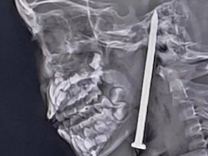 إنقاذ طفلة هندية بعد حادث مروع: معجزة طبية نادرة إنقاذ طفلة هندية بعد حادث مروع: معجزة طبية نادرة