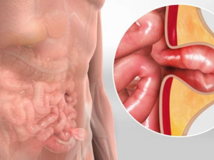 الفتق: حالة طبية تحتاج إلى اهتمام عاجل الفتق: حالة طبية تحتاج إلى اهتمام عاجل