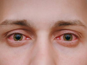 احمرار العين: مؤشر على مشكلات صحية خطيرة وأسباب متعددة احمرار العين: مؤشر على مشكلات صحية خطيرة وأسباب متعددة