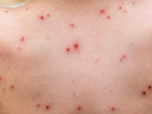 منظمة الصحة العالمية ترفع حالة الطوارئ بشأن جدري القرود بعد تراجع الإصابات منظمة الصحة العالمية ترفع حالة الطوارئ بشأن جدري القرود بعد تراجع الإصابات