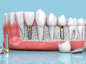 اكتشاف علمي في اليابان قد يحدث ثورة في طب الأسنان: جين جديد يمكن أن ينمو الأسنان مجددًا اكتشاف علمي في اليابان قد يحدث ثورة في طب الأسنان: جين جديد يمكن أن ينمو الأسنان مجددًا