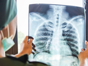 السل يتسبب في وفاة 1,23 مليون شخص خلال العام الماضي السل يتسبب في وفاة 1,23 مليون شخص خلال العام الماضي