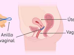 سقوط الحلقة المهبلية: ماذا تفعلين للحفاظ على فعاليتها؟