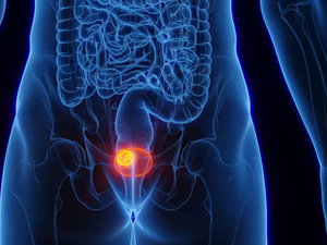 فيروس شائع قد يكون سبباً في سرطان المثانة: اكتشاف واعد