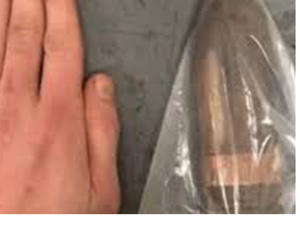 حادث قذيفة مدفعية من الحرب العالمية الأولى يثير الاستنفار في مستشفى رانغوييل بـتولوز