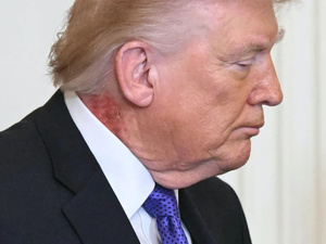 طفح جلدي على رقبة ترامب يثير تساؤلات… والطبيب يوضح