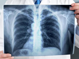 في اليوم العالمي للسل : 53% من الإصابات بالمغرب تصيب أعضاء الجسم خارج الرئتين