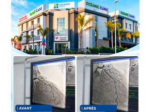 OceanicClinic El Hana تنجز تفتيتاً داخل الشريان التاجي لعلاج تكلسات شديدة لدى مريض فوق 70 عاماً