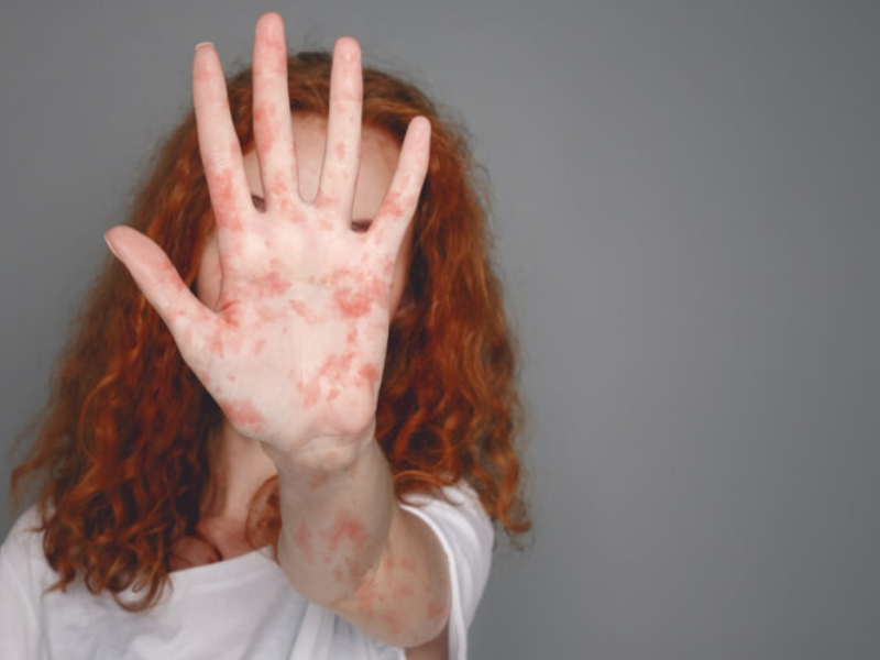 الحصبة عند الكبار: أسبابها، أعراضها، وكيفية الوقاية والعلاج الحصبة عند الكبار: أسبابها، أعراضها، وكيفية الوقاية والعلاج