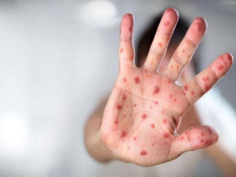 حملة توعوية واسعة.. وزارتي الصحة والتعليم يتحركان لمجابهة تفشي الحصبة حملة توعوية واسعة.. وزارتي الصحة والتعليم يتحركان لمجابهة تفشي الحصبة