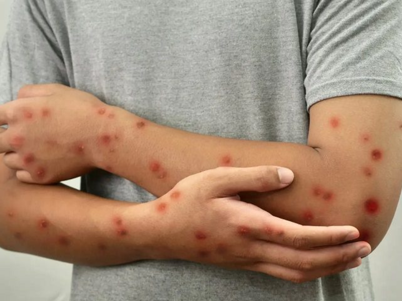 زيارات ميدانية للمجلس الوطني لحقوق الإنسان لتقييم تدابير مكافحة الحصبة في السجون زيارات ميدانية للمجلس الوطني لحقوق الإنسان لتقييم تدابير مكافحة الحصبة في السجون