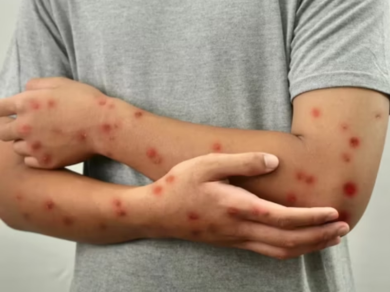 حصيلة الحصبة في المغرب : 2863 إصابة و8 وفيات خلال أسبوع حصيلة الحصبة في المغرب : 2863 إصابة و8 وفيات خلال أسبوع