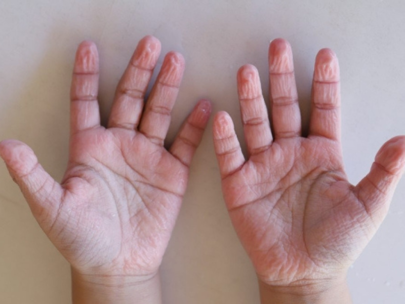 تجعد أصابع اليدين والقدمين: الحقائق العلمية وراء الظاهرة تجعد أصابع اليدين والقدمين: الحقائق العلمية وراء الظاهرة