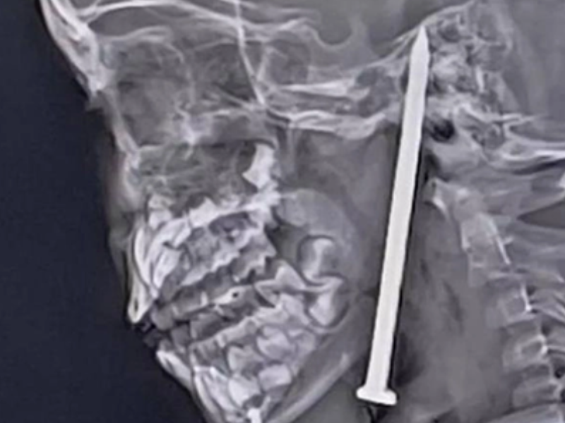 إنقاذ طفلة هندية بعد حادث مروع: معجزة طبية نادرة إنقاذ طفلة هندية بعد حادث مروع: معجزة طبية نادرة