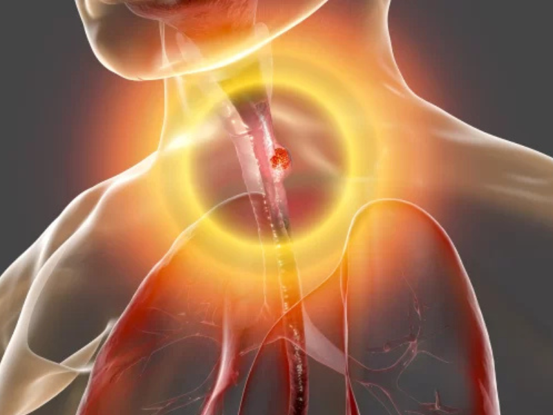 تطوير كبسولة تنظيرية صغيرة للكشف المبكر عن سرطان المريء تطوير كبسولة تنظيرية صغيرة للكشف المبكر عن سرطان المريء