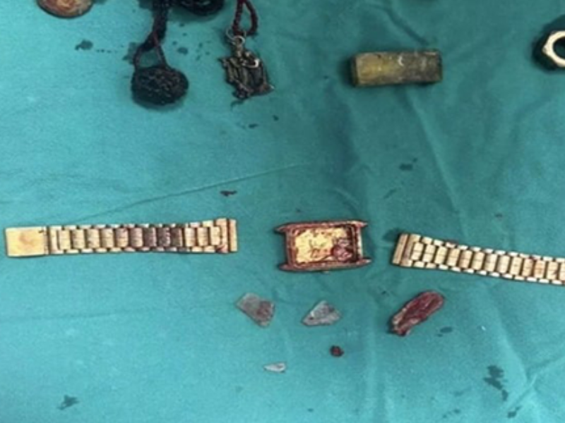 ساعات ومسامير وأقلام داخل المعدة: حوادث غريبة تكشف علاقة الاضطرابات النفسية بالسلوكيات الخطرة