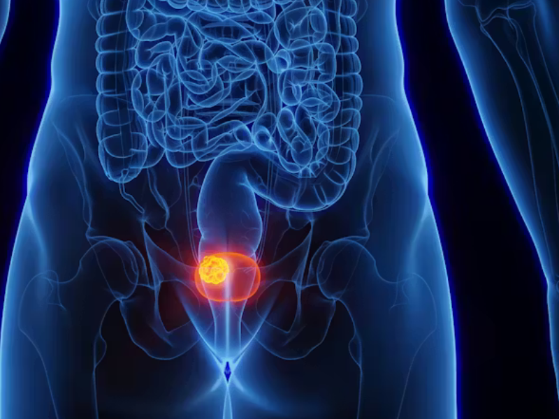 فيروس شائع قد يكون سبباً في سرطان المثانة: اكتشاف واعد
